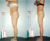 endermologie_1